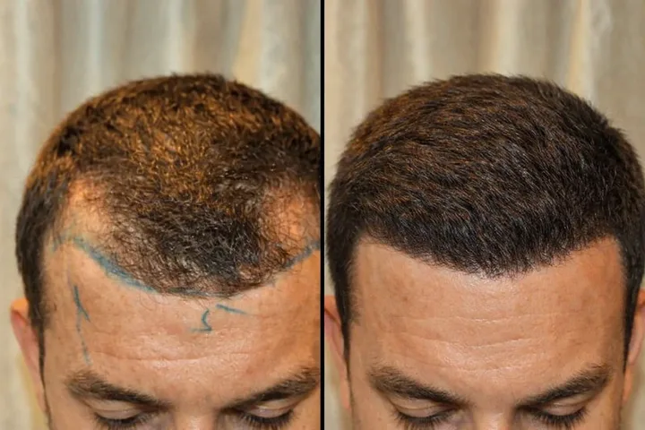 Frontal Thinning
