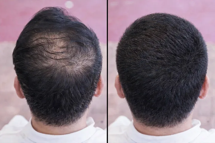 Bald Spots