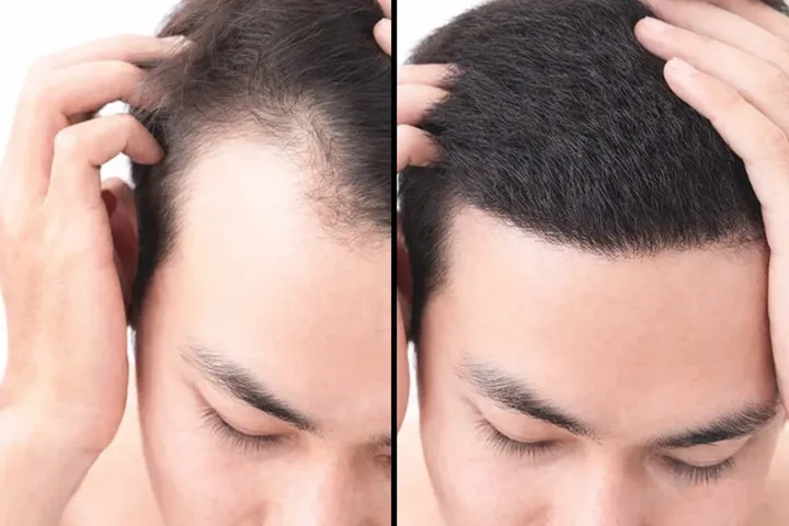Temple Hair Loss