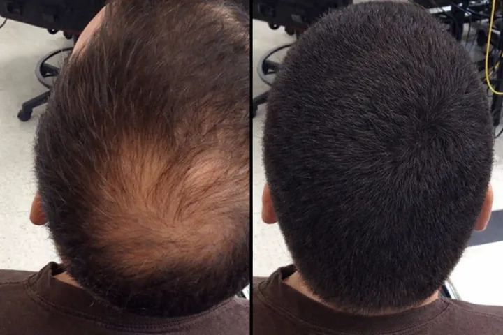 Central Scalp Thinning